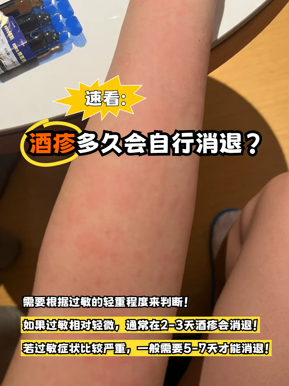 酒精肝有哪些症状