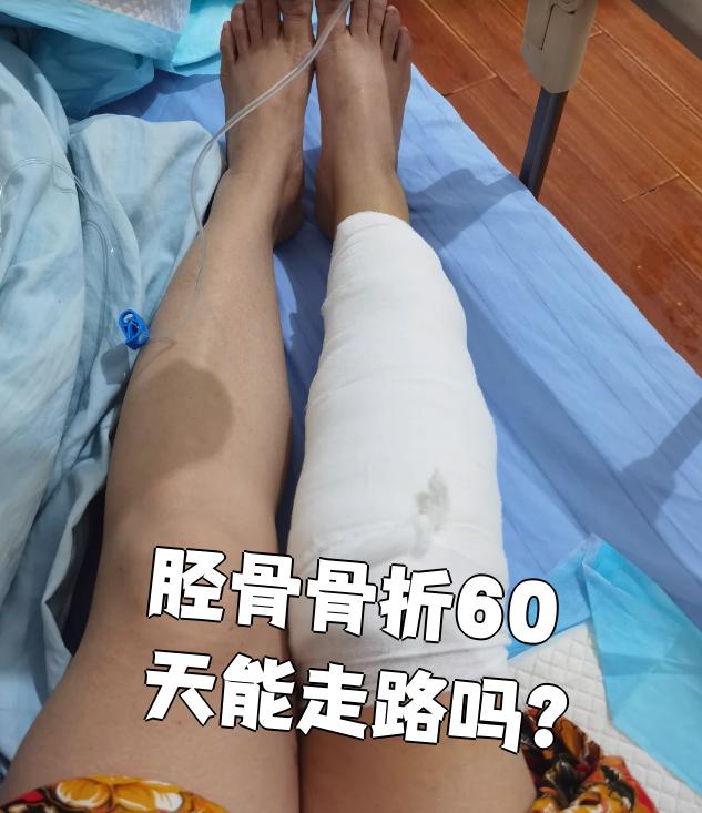 胫骨骨折愈合时间