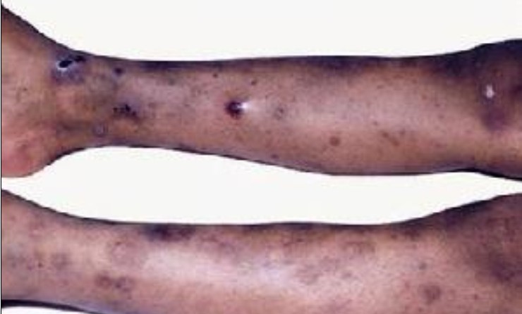 血小板低的症状有哪些?