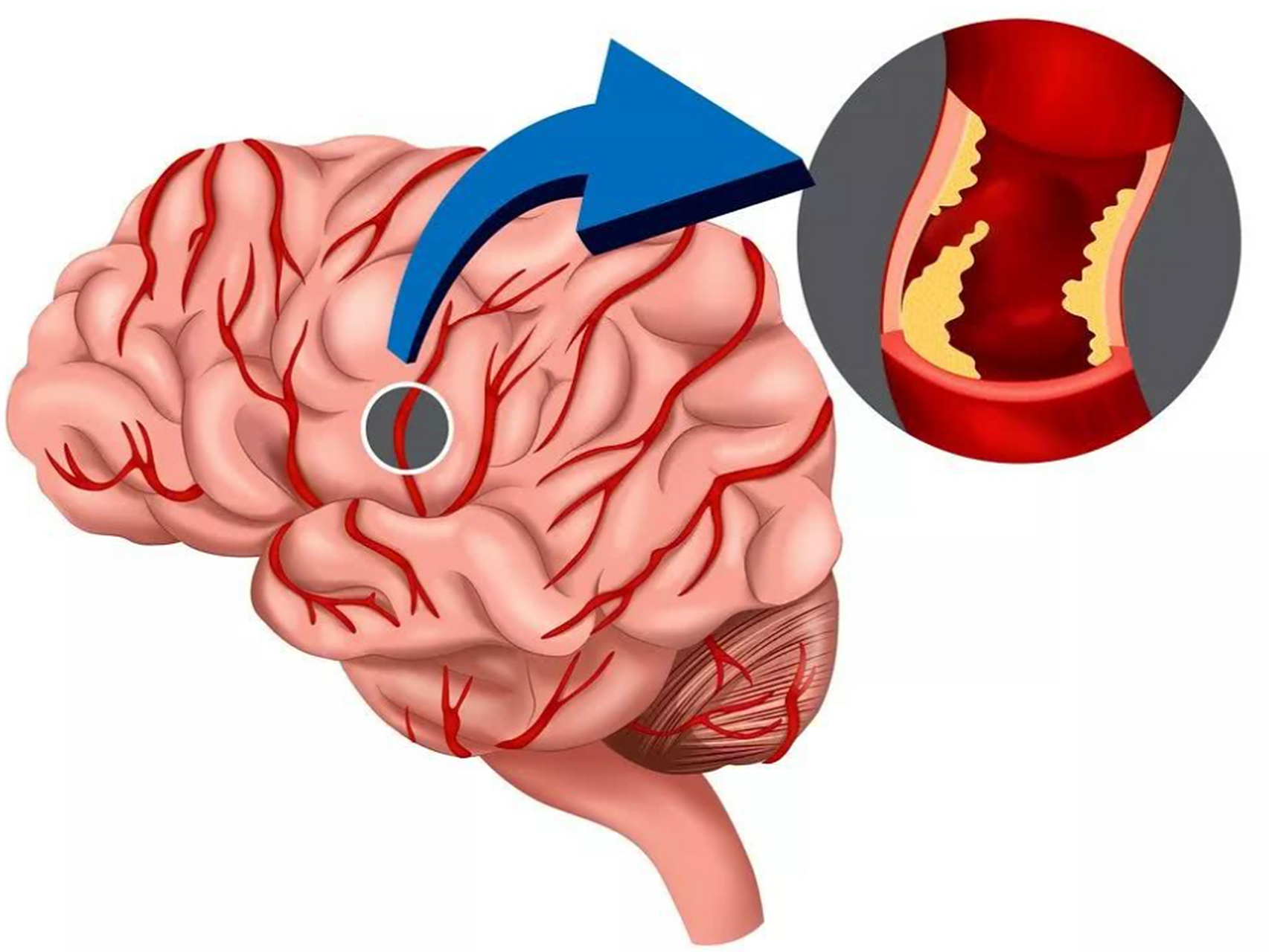 脑血管阻塞有哪些症状