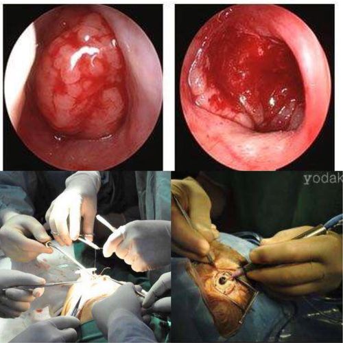 鼻息肉是什么样子