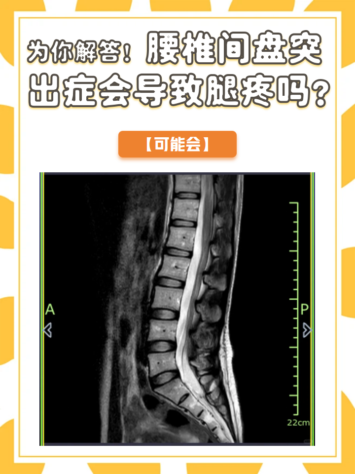 腰椎退行性改变是什么意思