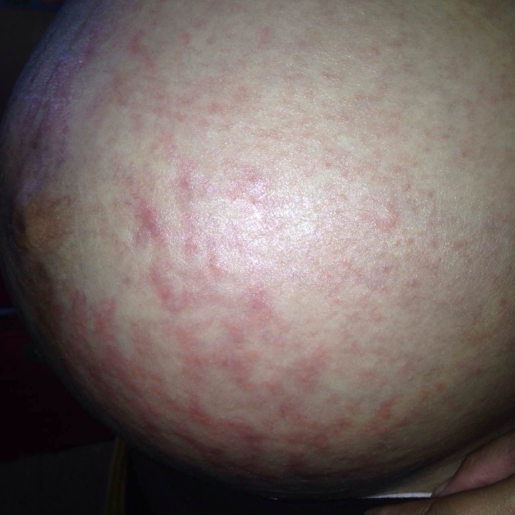 孕晚期肚皮痒怎么回事