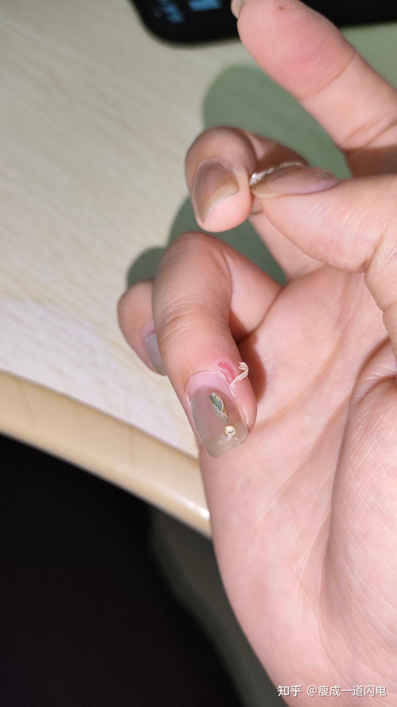 男,19岁,手指有倒刺且肿胀