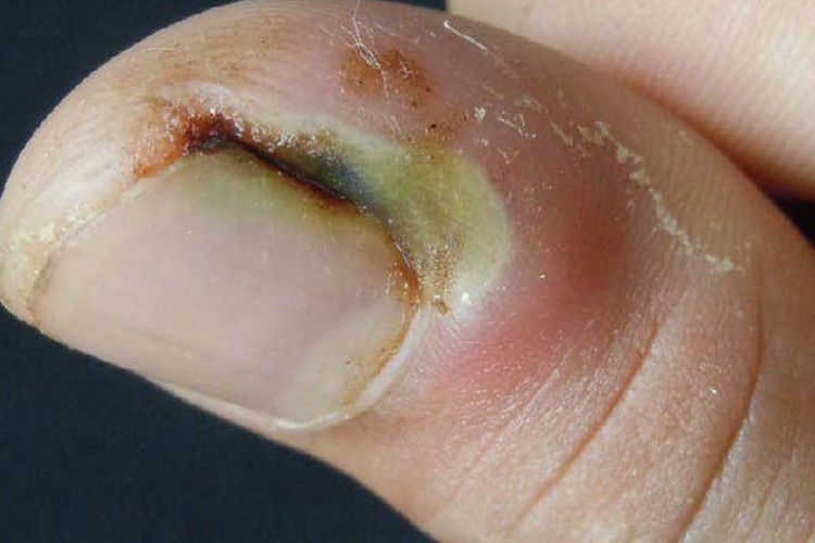 男,19岁,手指有倒刺且肿胀