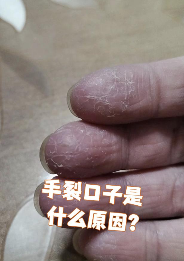 口角裂口子是什么原因