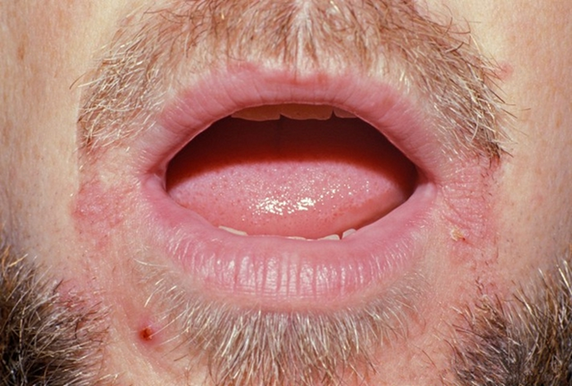 口角裂口子是什么原因