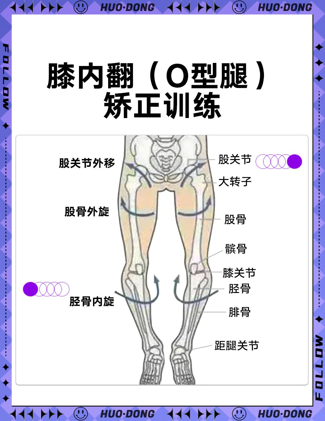 如何矫正罗圈腿