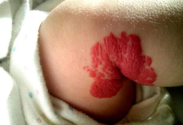 皮肤上有红色斑点是什么原因