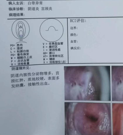 白带多是怎么回事