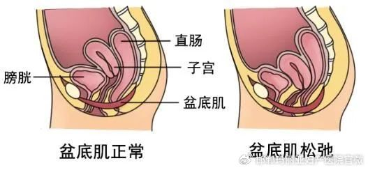 什么是子宫直肠窝见液性暗区
