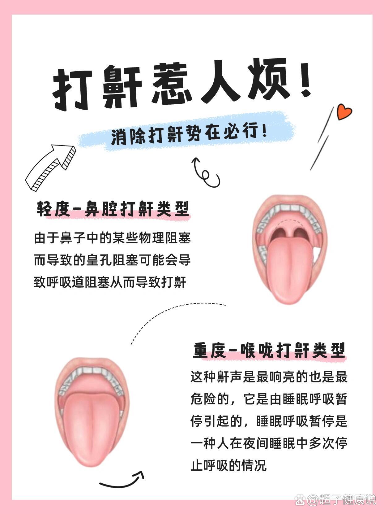 总打呼噜怎么办