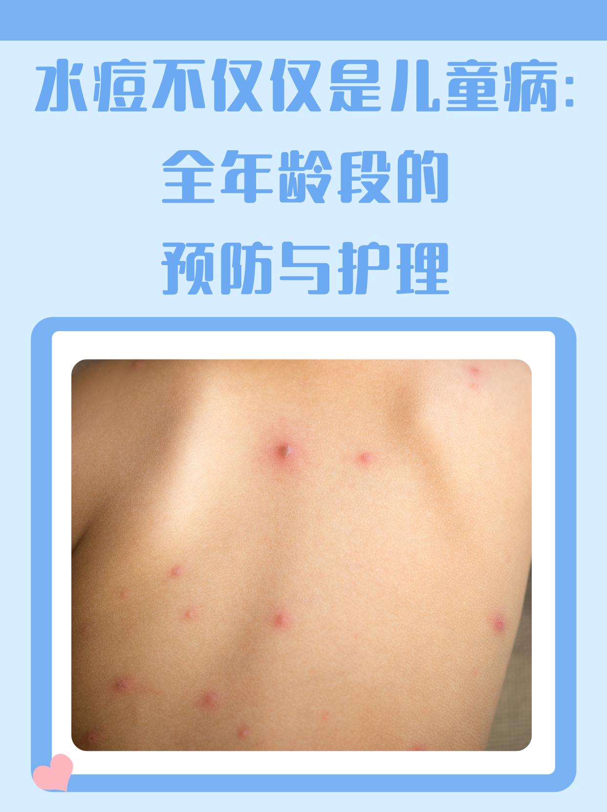 水痘传染期是多久