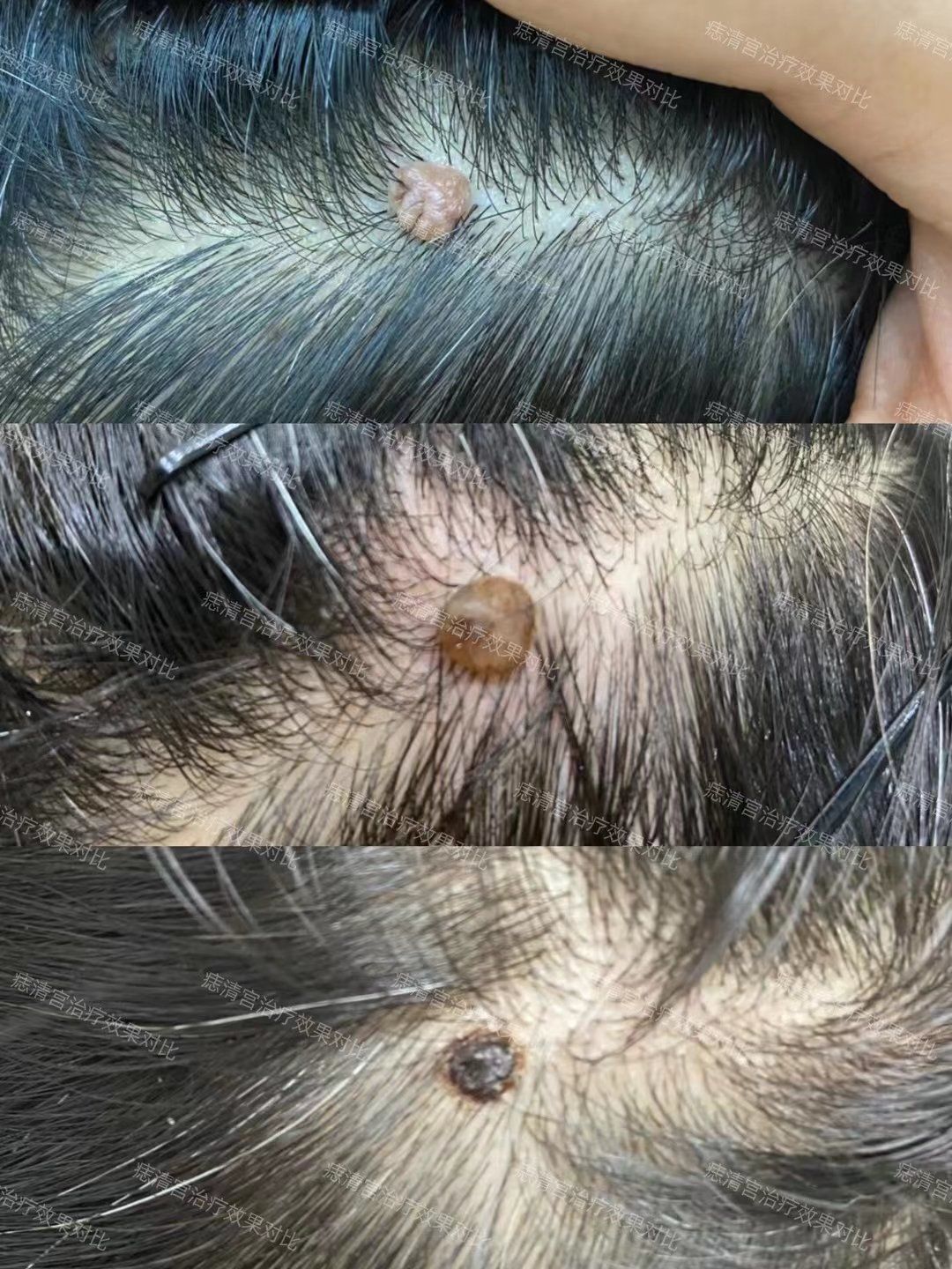 头上长肉疙瘩怎么回事