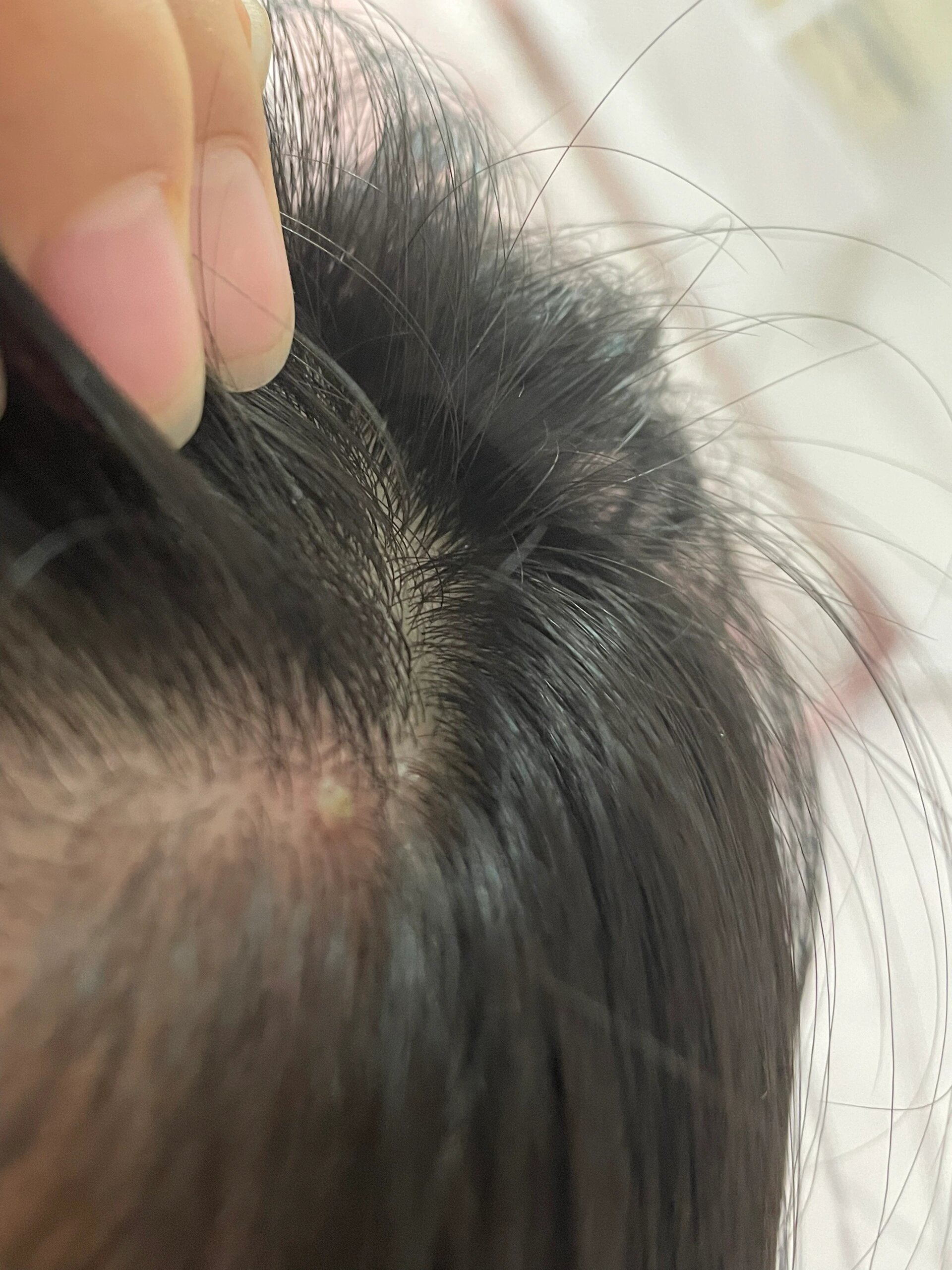 头上长肉疙瘩怎么回事