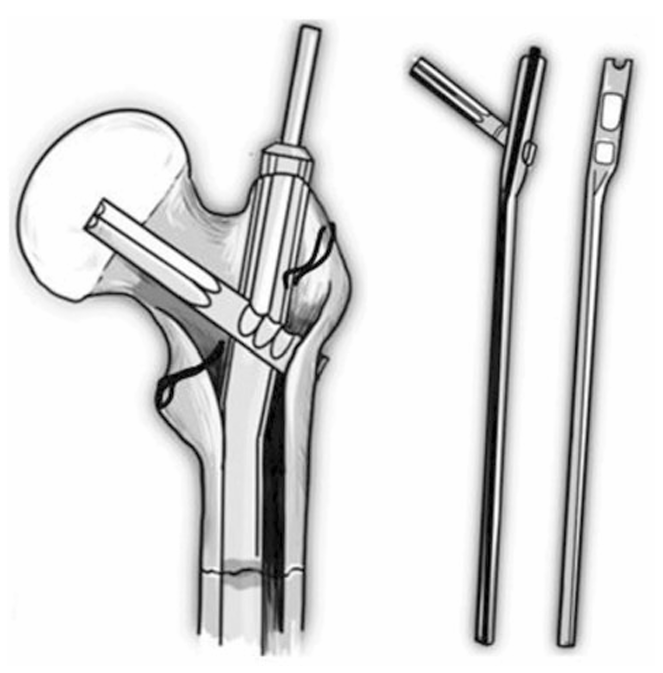 股骨转子间骨折怎么办