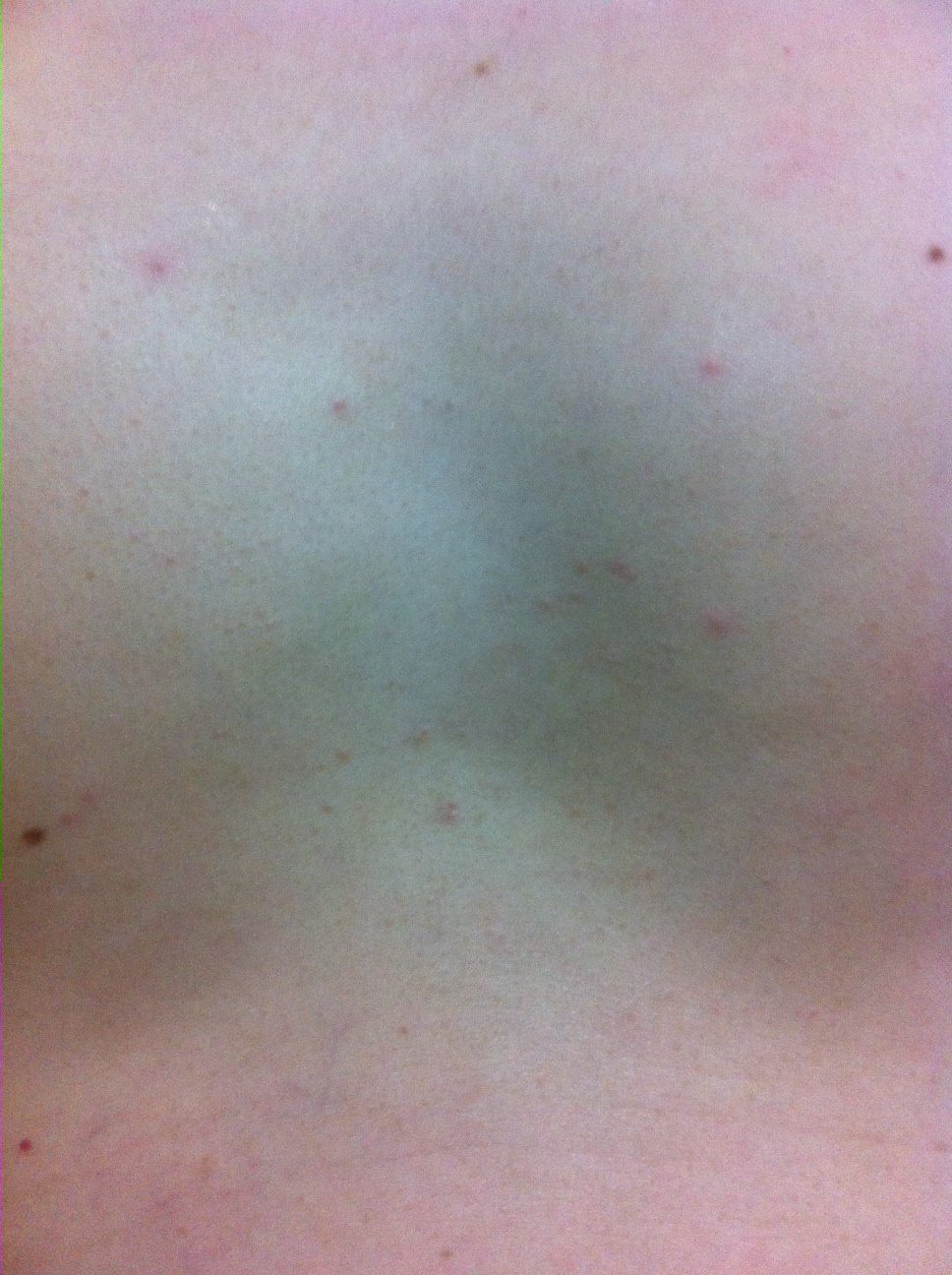 身上起小红点,像红痣一样