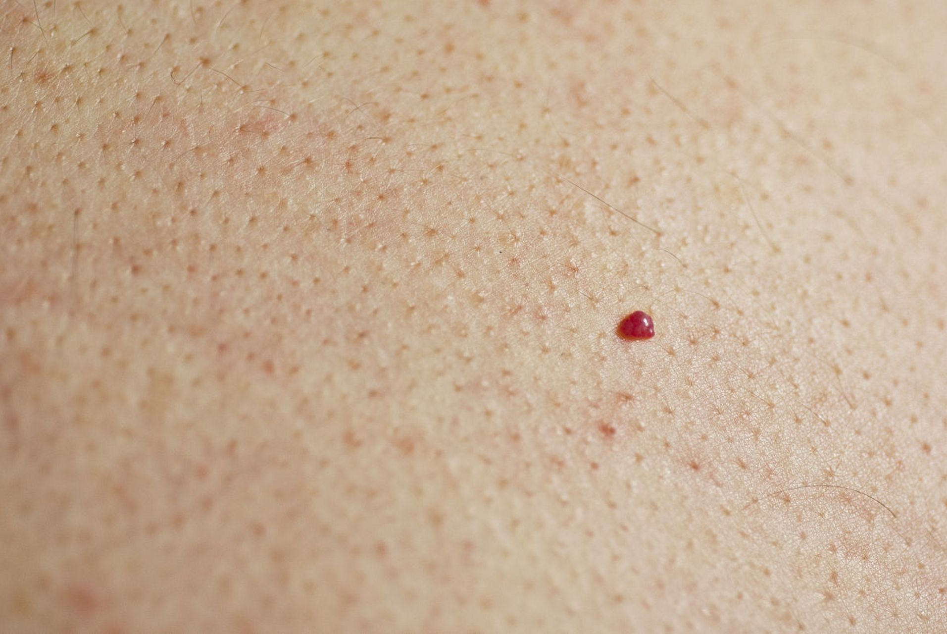 身上起小红点,像红痣一样