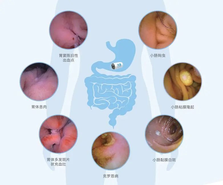 结肠癌的早期症状及表现