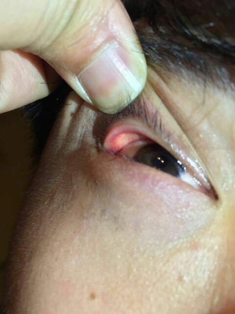 眼睛里面长了个小白点