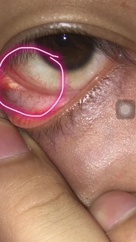 眼睛里面长了个小白点