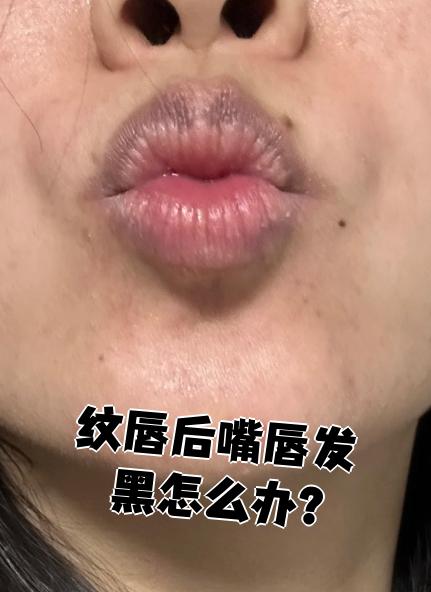 嘴角发黑怎么回事
