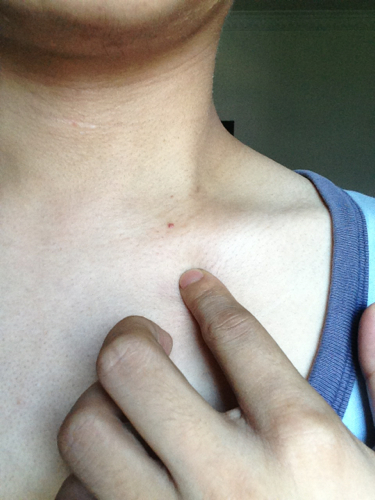 脖子上的红点是艾滋病的前兆吗?