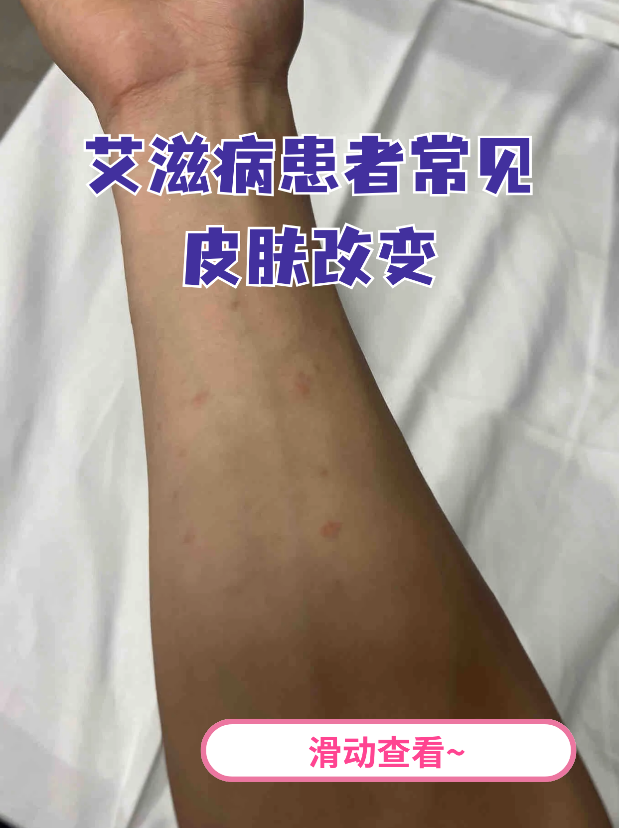 脖子上的红点是艾滋病的前兆吗?