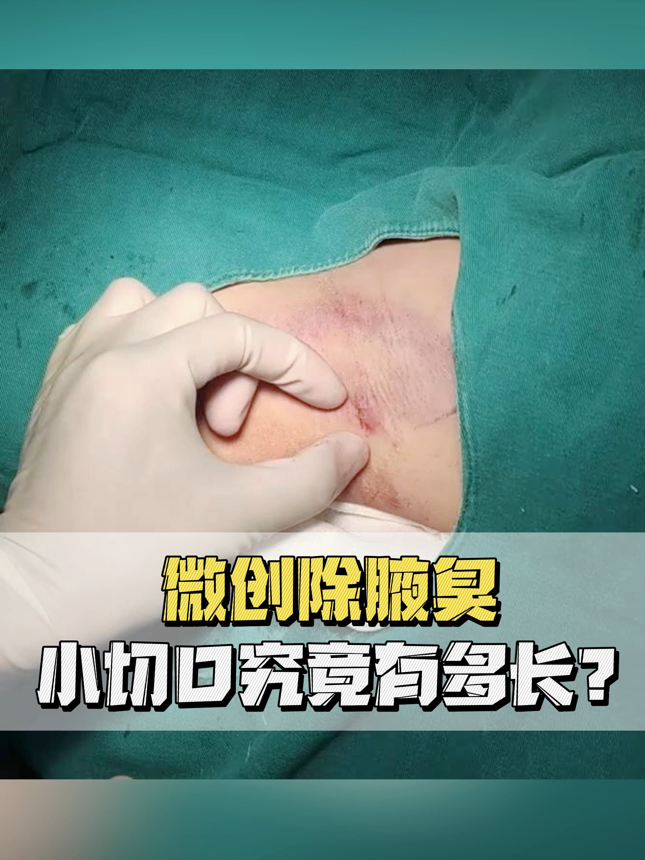 狐臭能够根除吗?