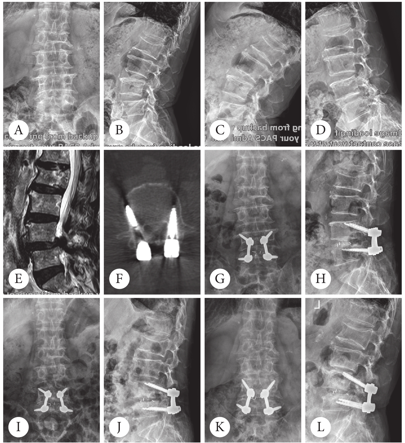 Ollier病临床表现及X线表现?