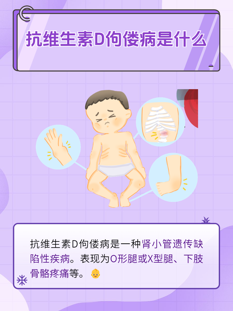 佝偻病是什么病