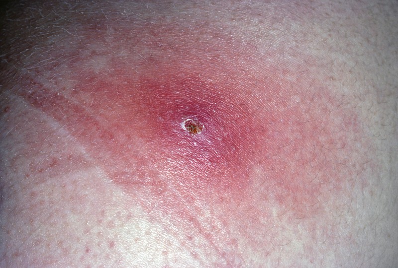 屁股上长红疙瘩很痒