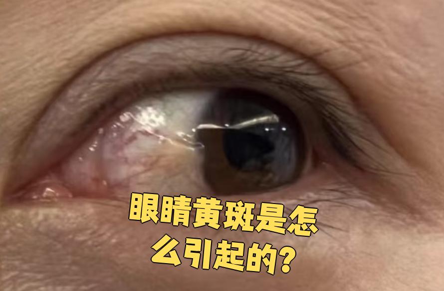 眼睛发黄,是怎么回事