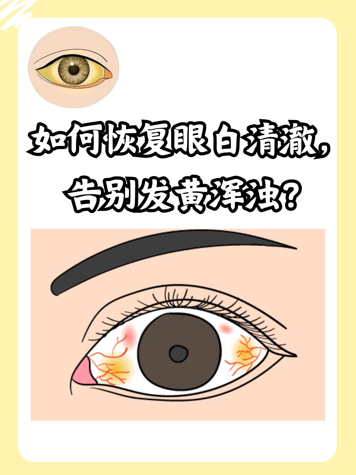 眼睛发黄,是怎么回事