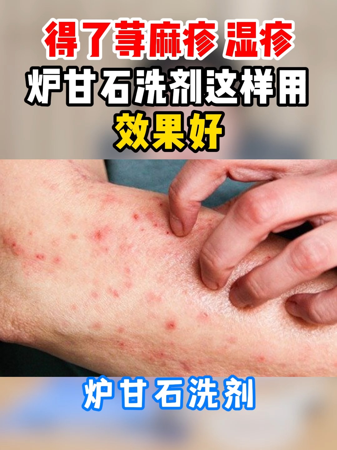 荨麻疹可以洗澡吗?