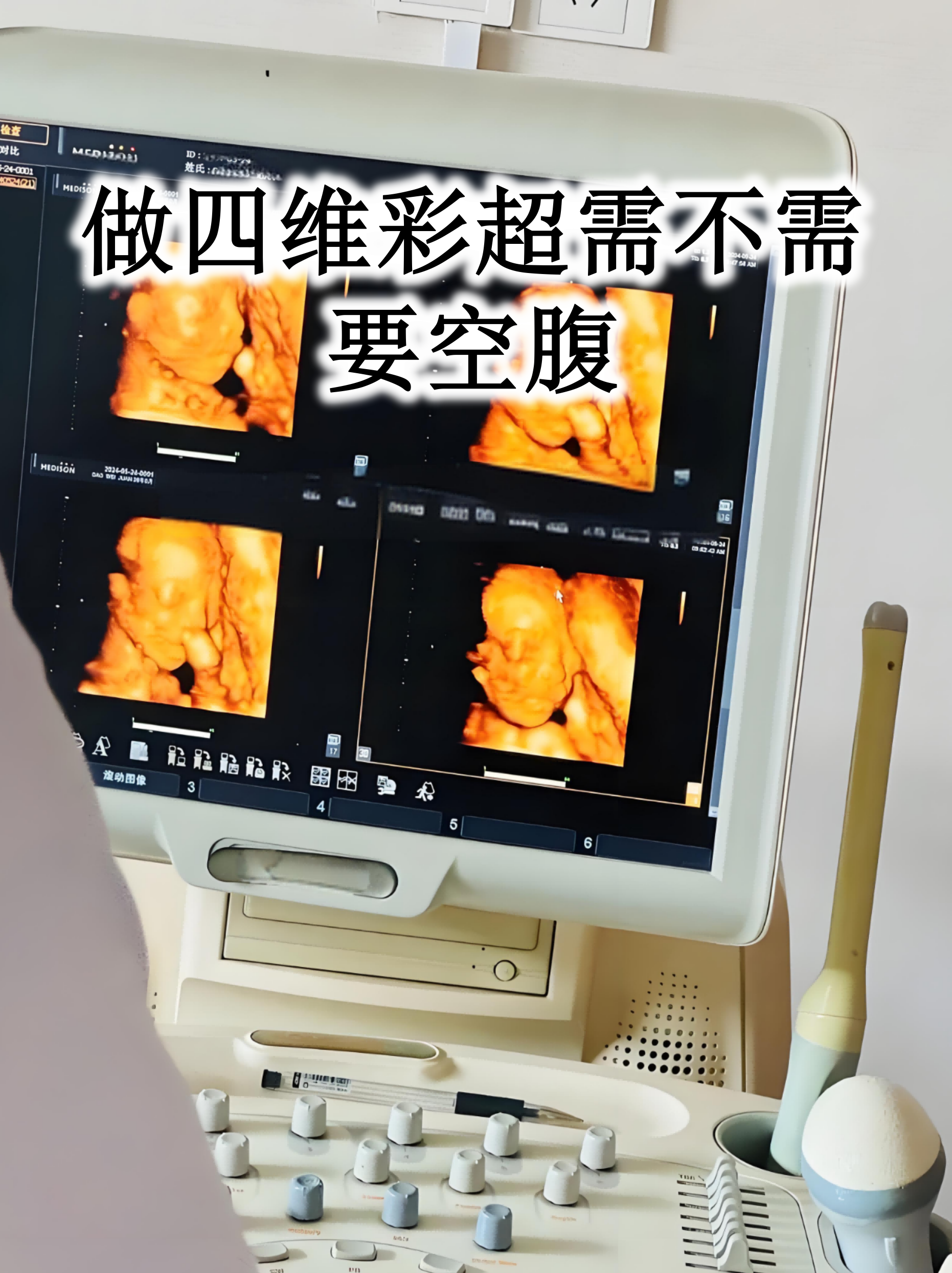 四维彩超几月做