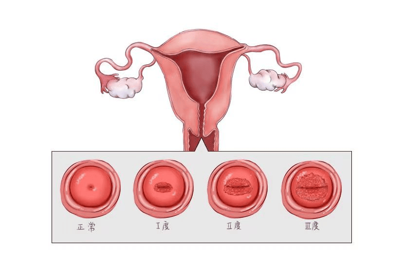 慢性宫颈炎（附图）