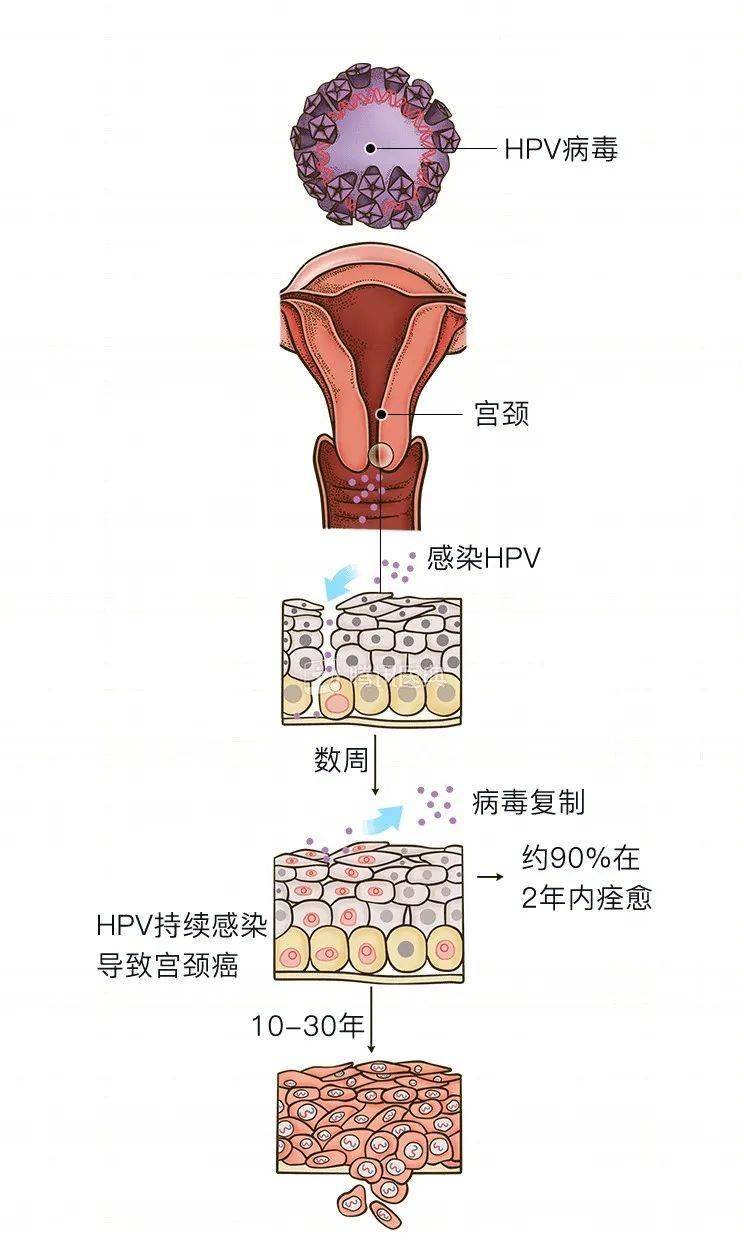 慢性宫颈炎(附图)