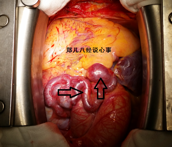 心脏肿瘤都有什么分类