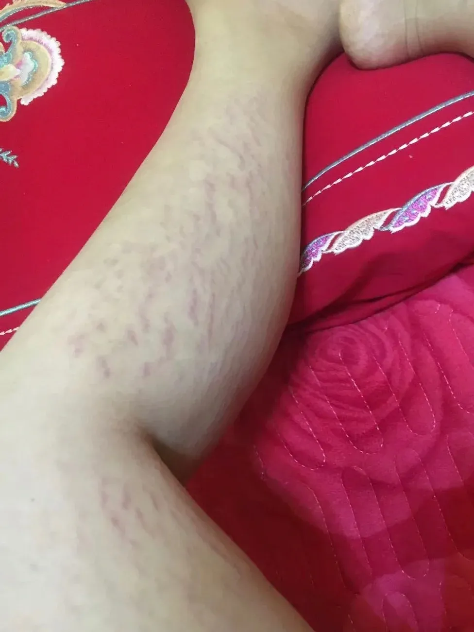 大腿内侧出现肥胖纹........