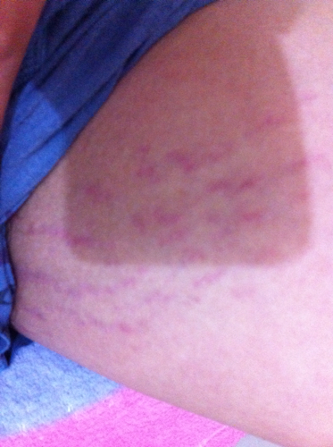 大腿内侧出现肥胖纹........