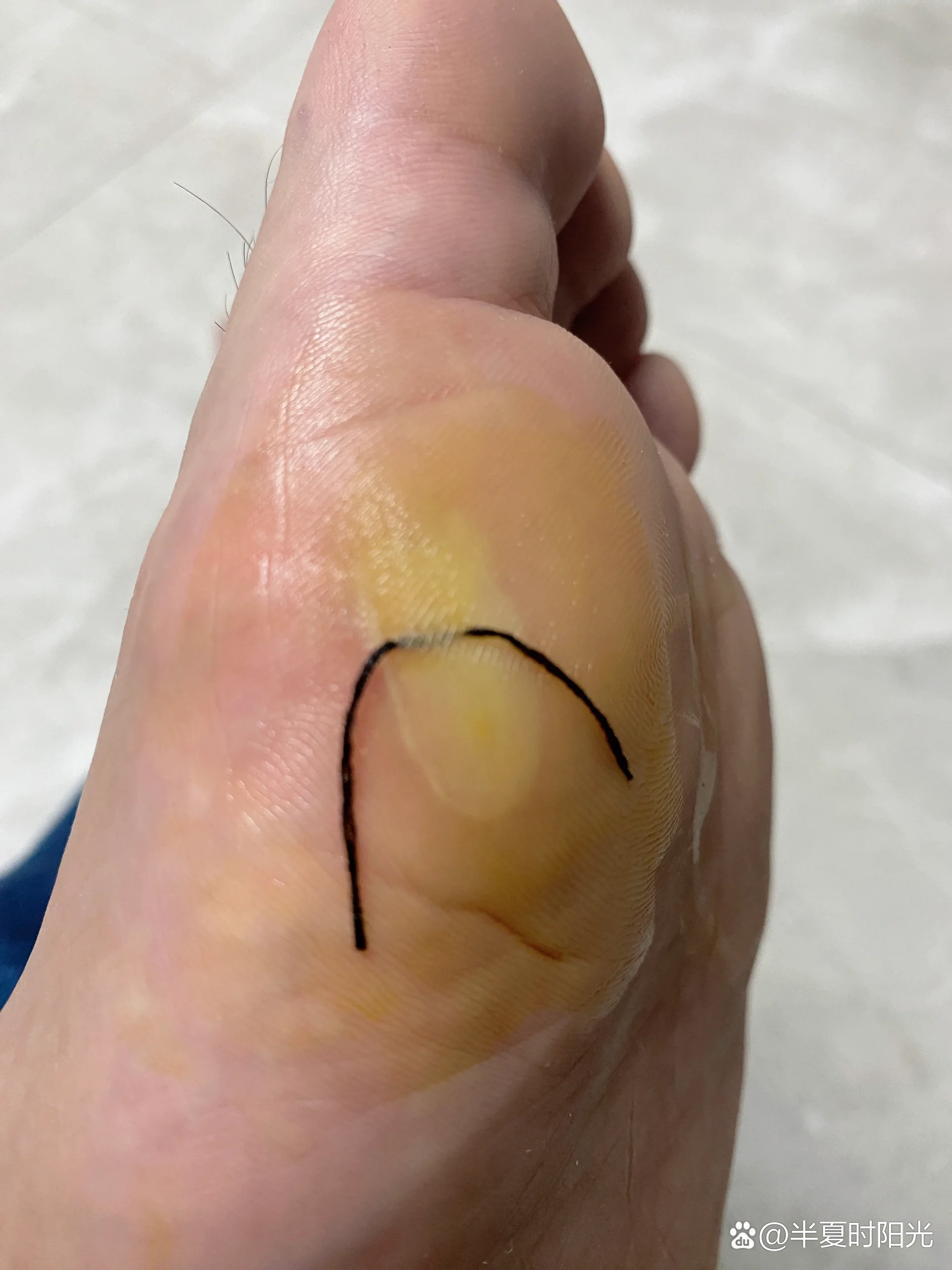 脚磨出水泡,怎么办呢