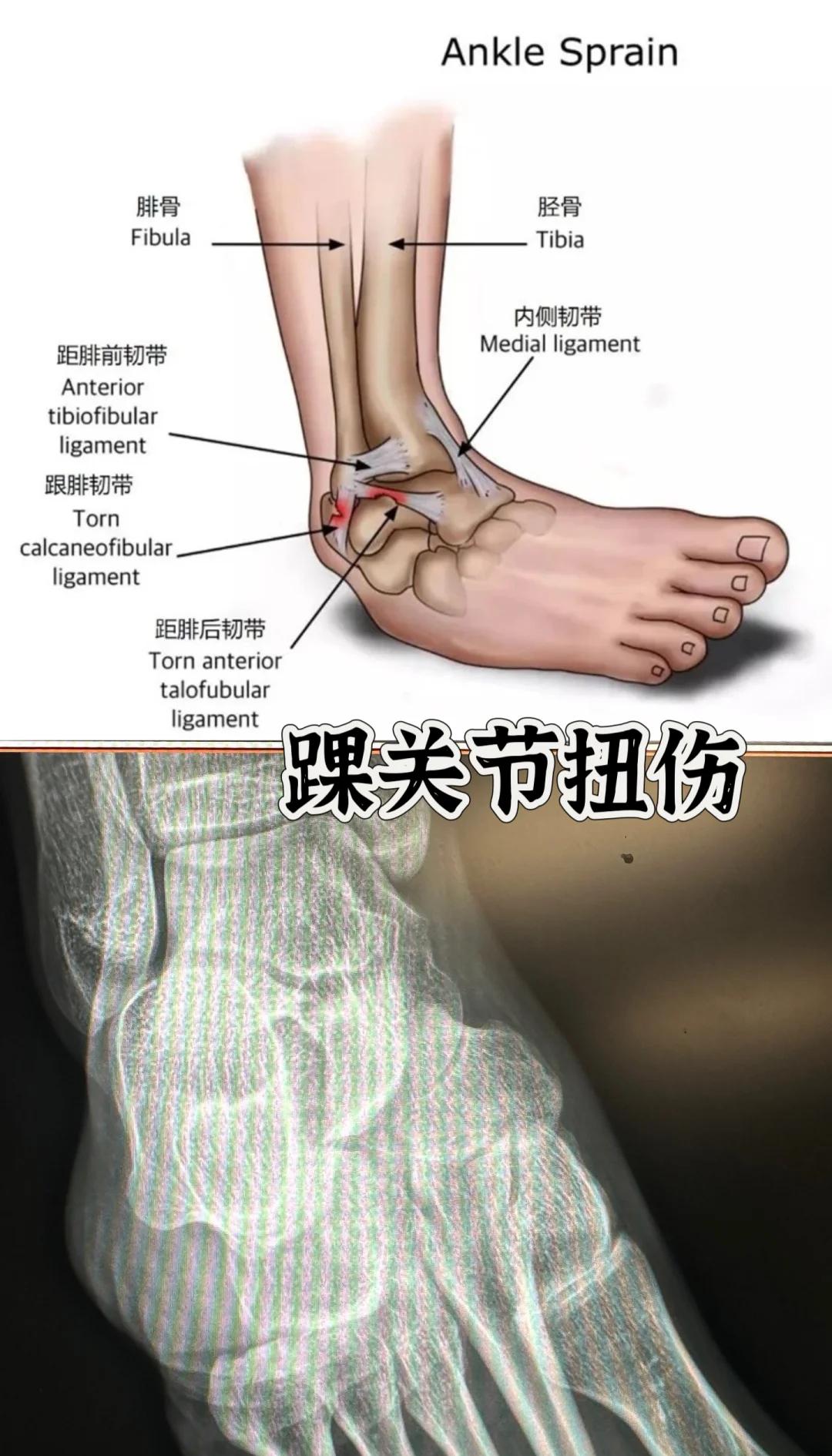 治疗韧带拉伤的方法有几种