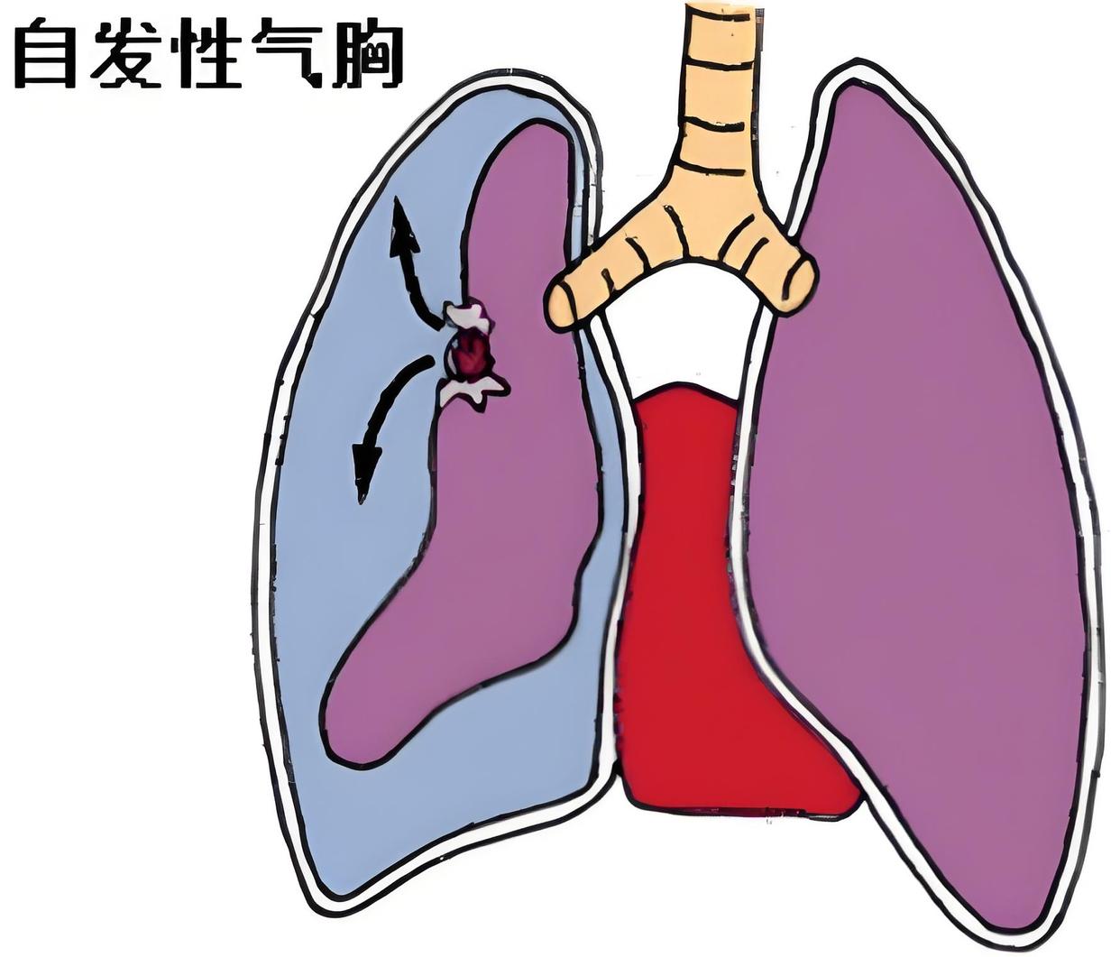 张力性气胸的病因有几种