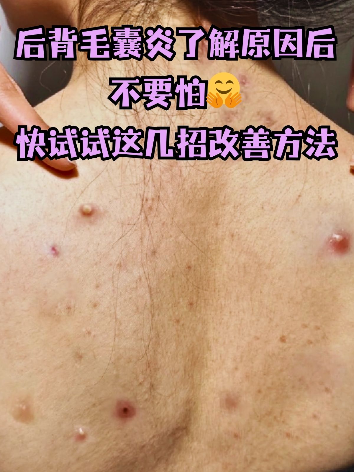 后背疙瘩痒是螨虫吗