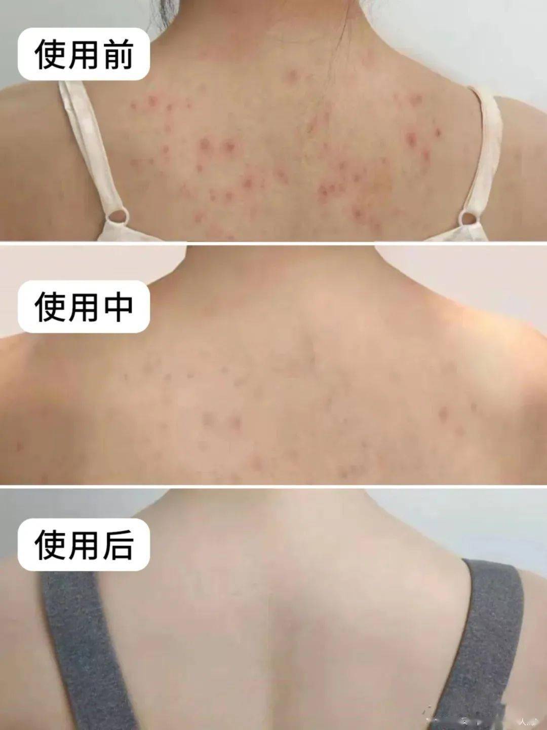 后背疙瘩痒是螨虫吗