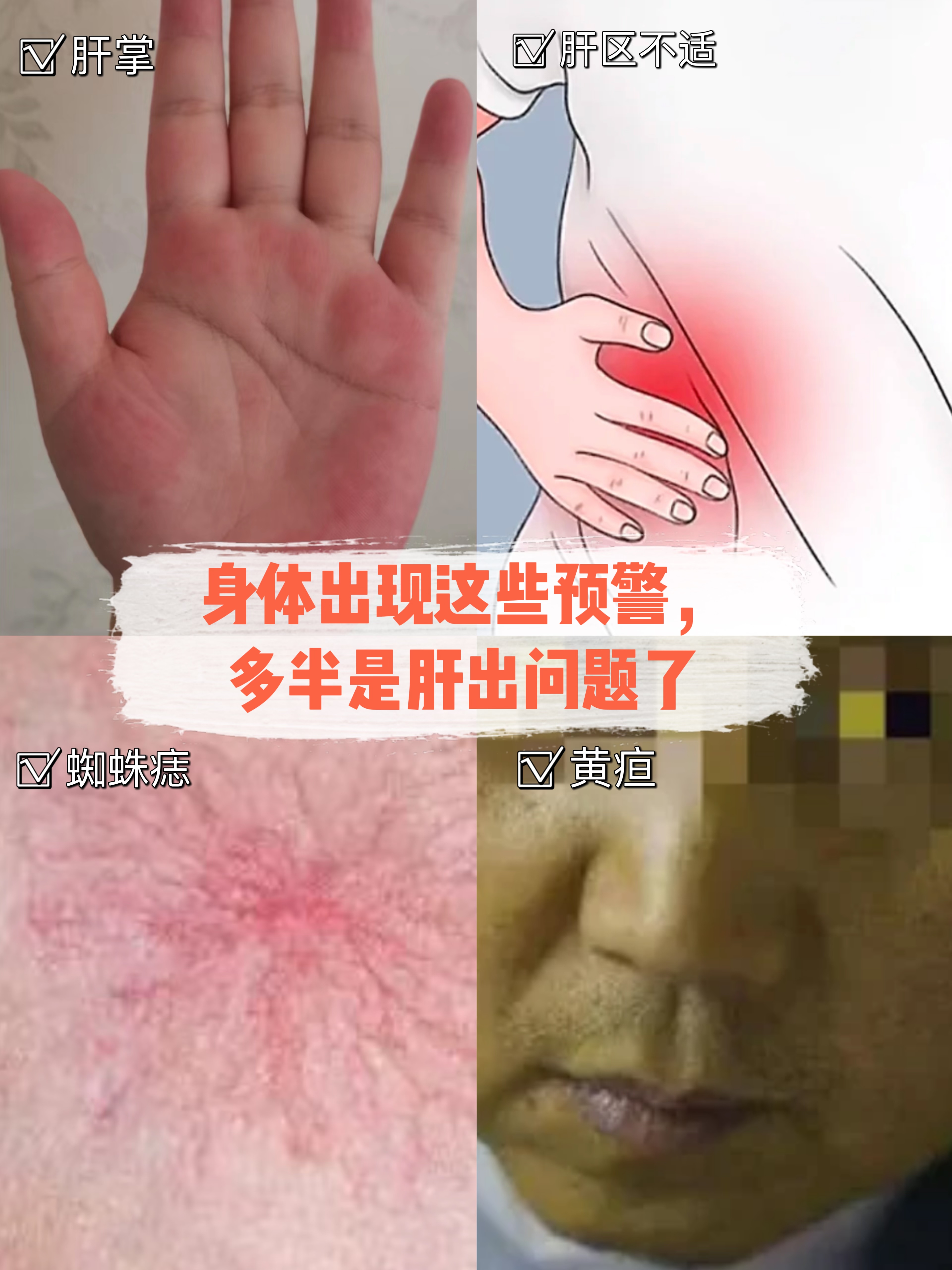 肝硬化早期症状是什么?