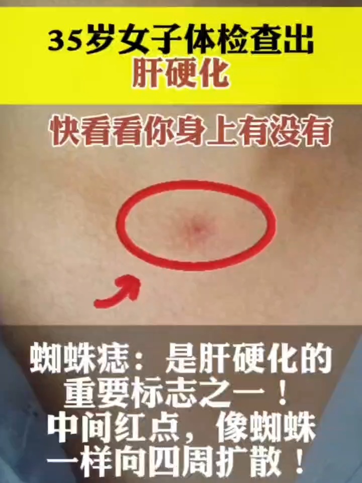 肝硬化早期症状是什么?