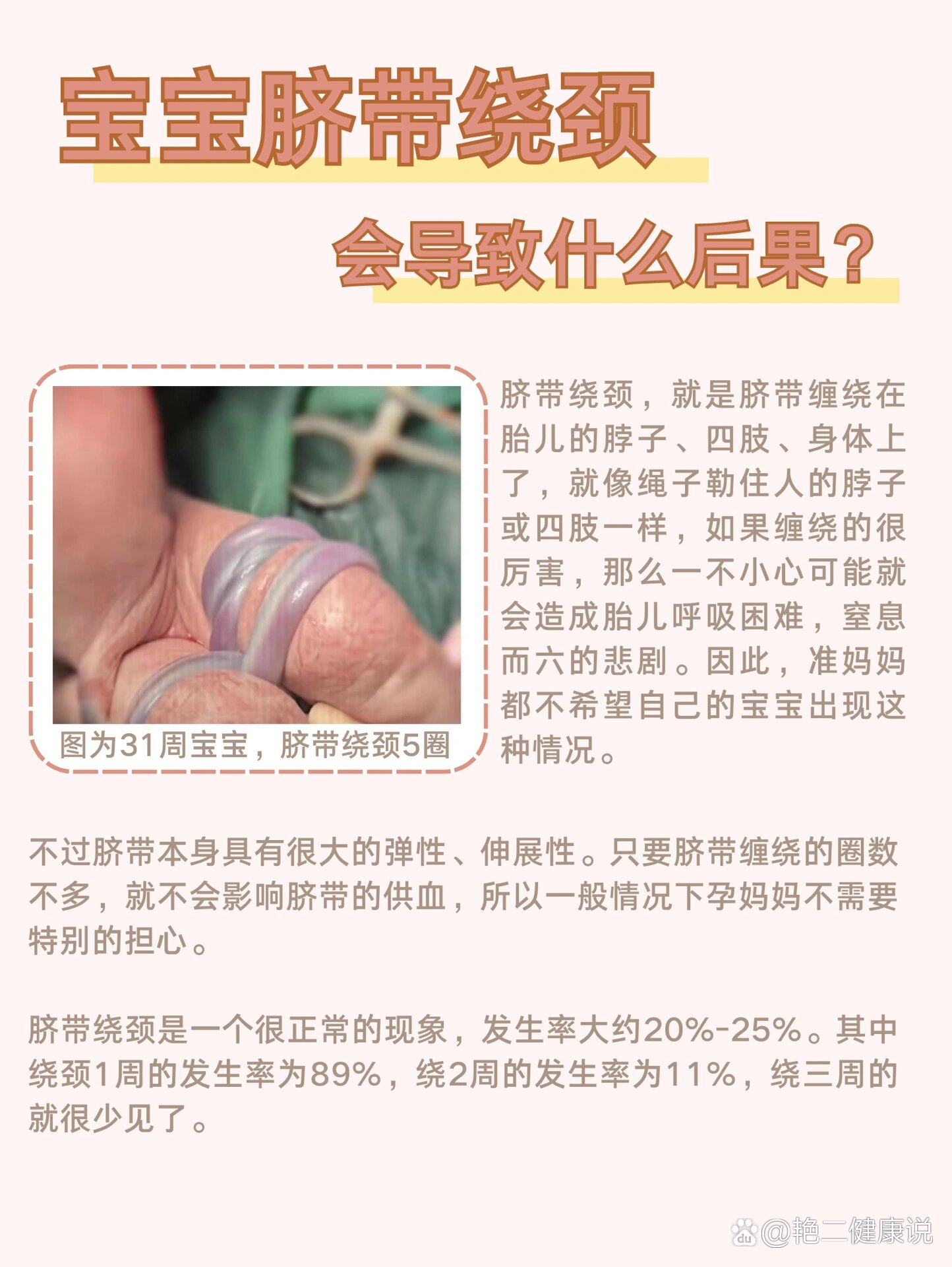 胎儿脐带绕颈一周怎么办??