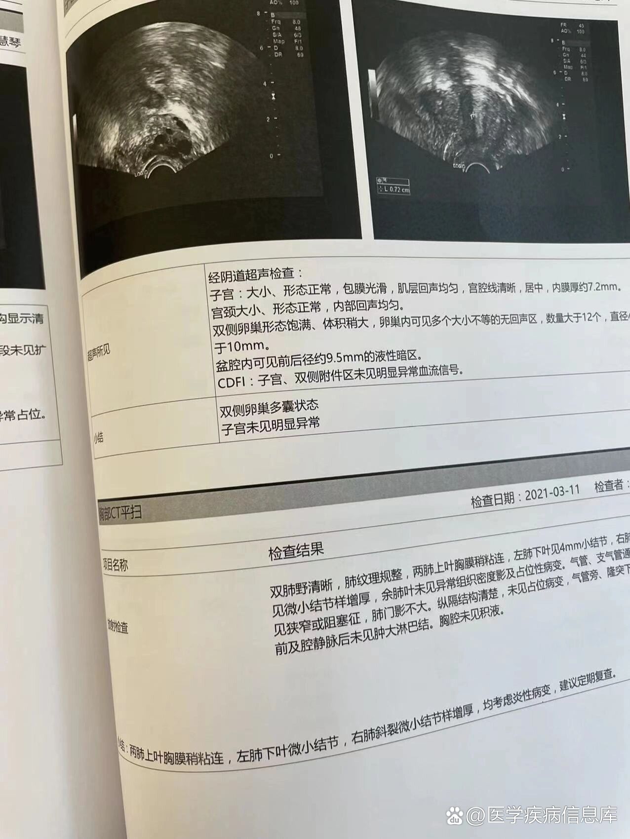 双侧卵巢呈多囊样改变是什么意思